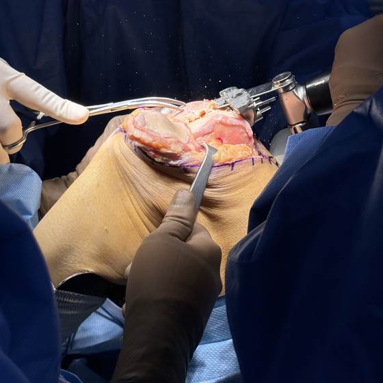 Caso real de artroplastia de rodilla 01