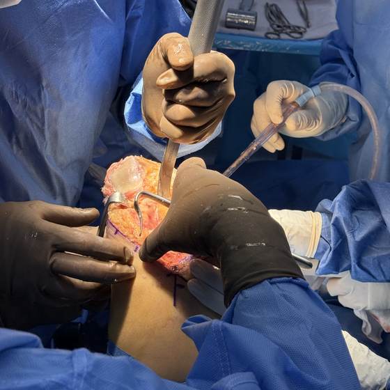 Caso real de artroplastia de rodilla 02