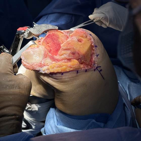 Caso real de artroplastia de rodilla 05