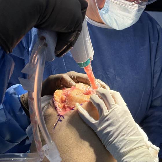 Caso real de artroplastia de rodilla 17